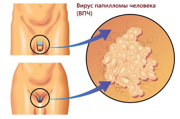 HPV u žena - što je to, simptomi, vrste, kako se prenosi, liječenje humanog papiloma virusa u ginekologiji