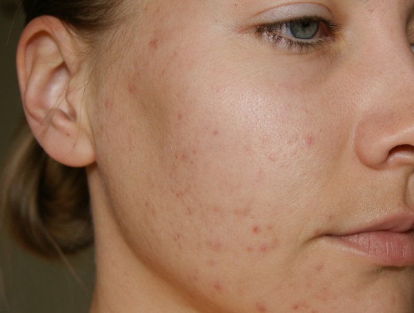 Remèdes contre les taches d'acné sur le visage. Le meilleur de la pharmacie et le folk efficace. Comment éliminer rapidement la pigmentation à la maison